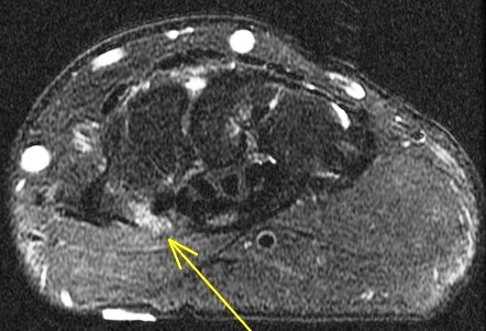 Figure 6 for case trapezial tubercle fracture ( RID2193 )